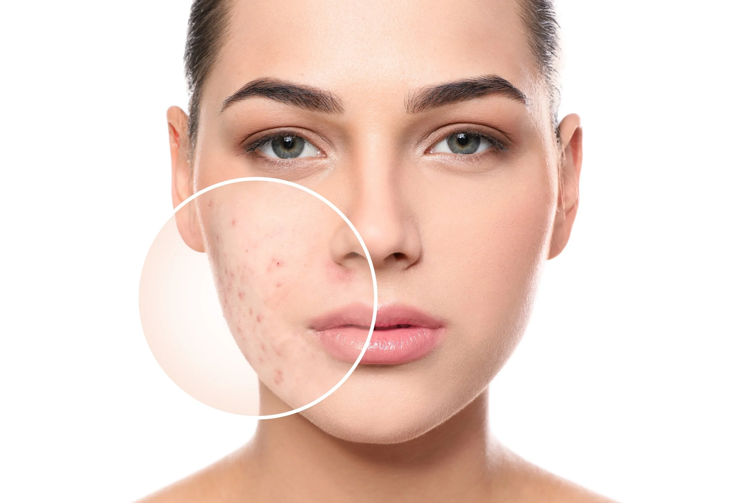 acne facial
