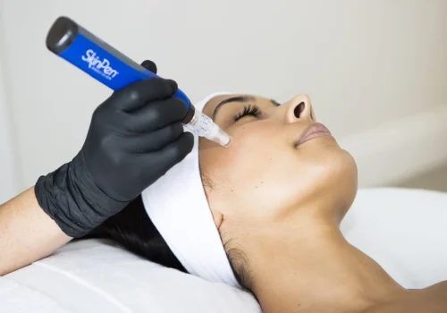 SkinPen Microneedling