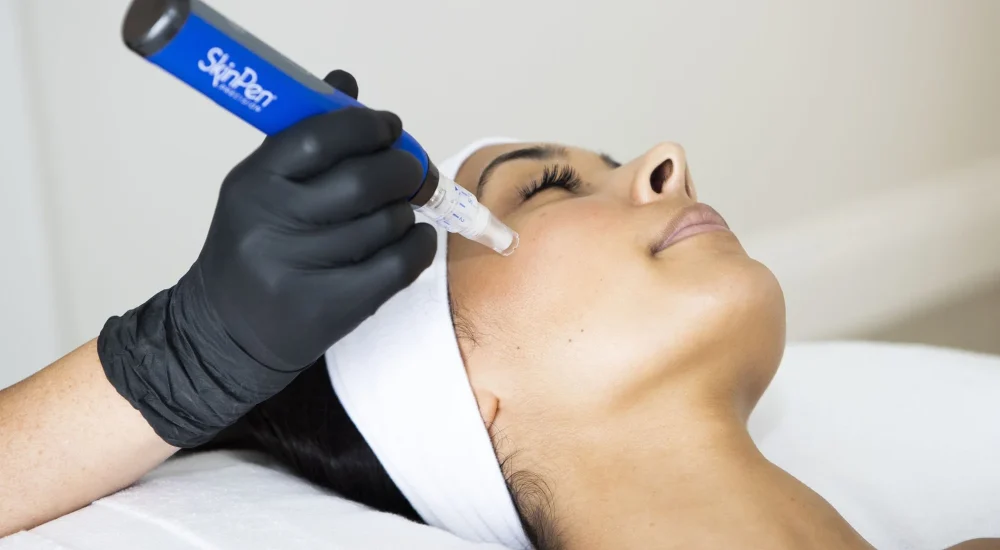 SkinPen Microneedling