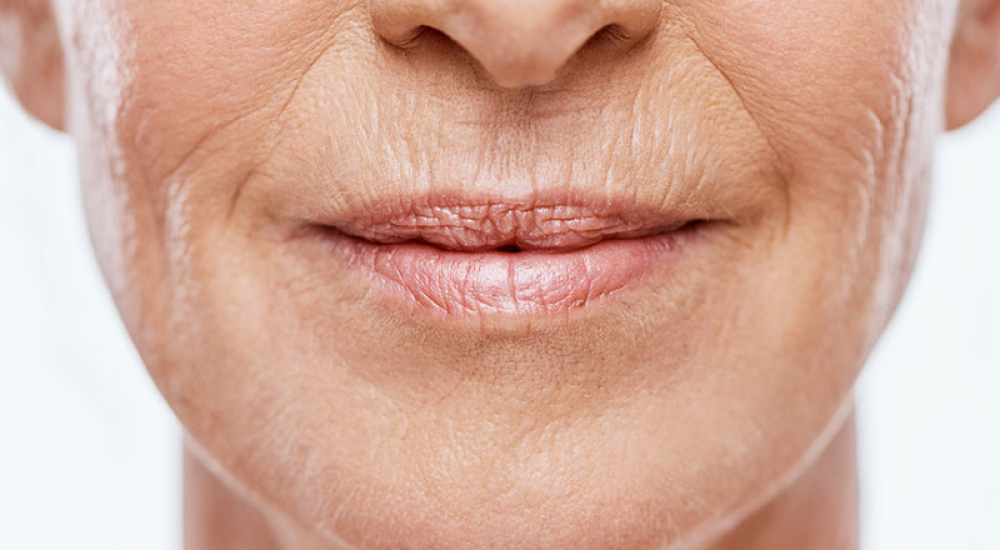 Smile Lines & Lower Face